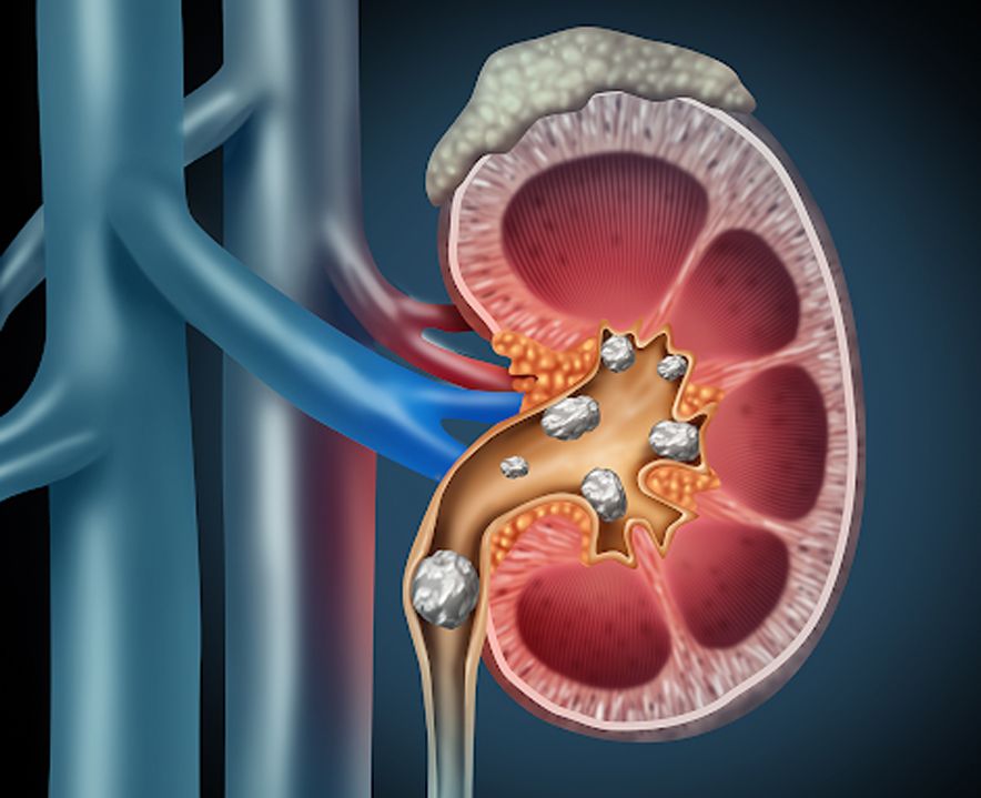 Why Are Kidney Stone Cases Increasing In Summer?